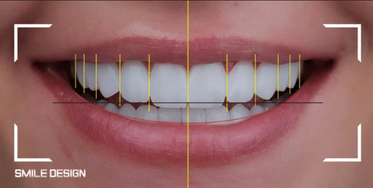 Smile Designing