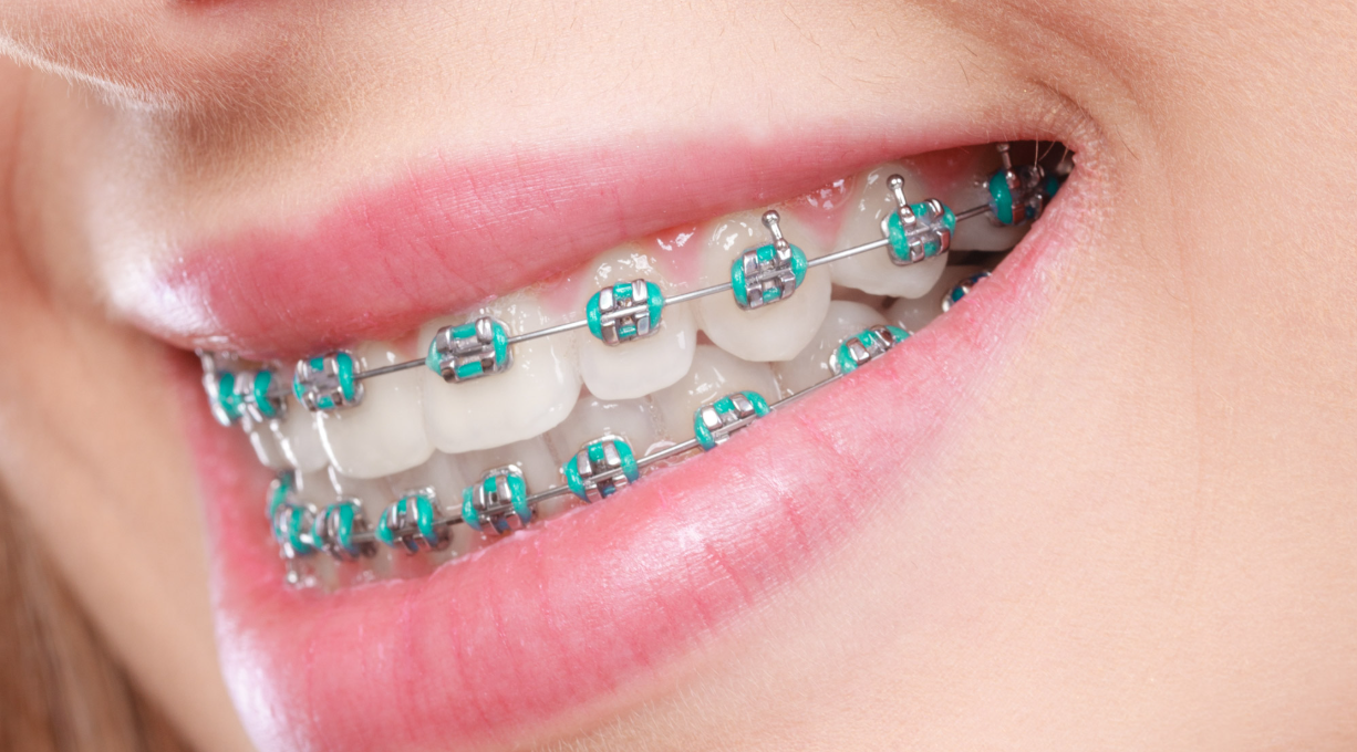 Braces & Orthodontics