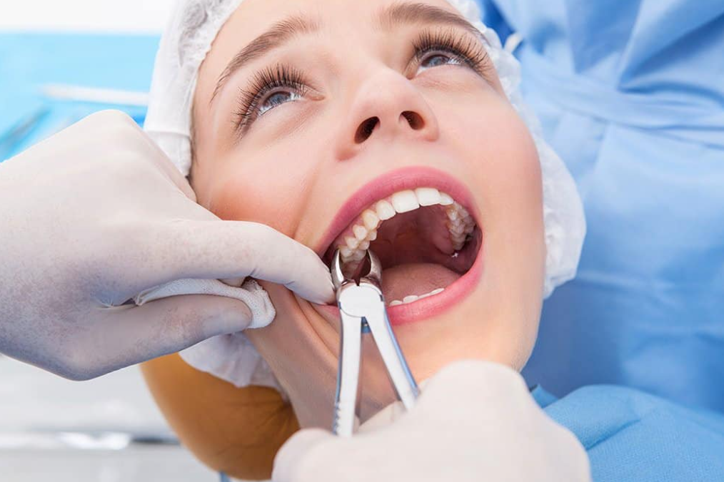 Tooth Extractions