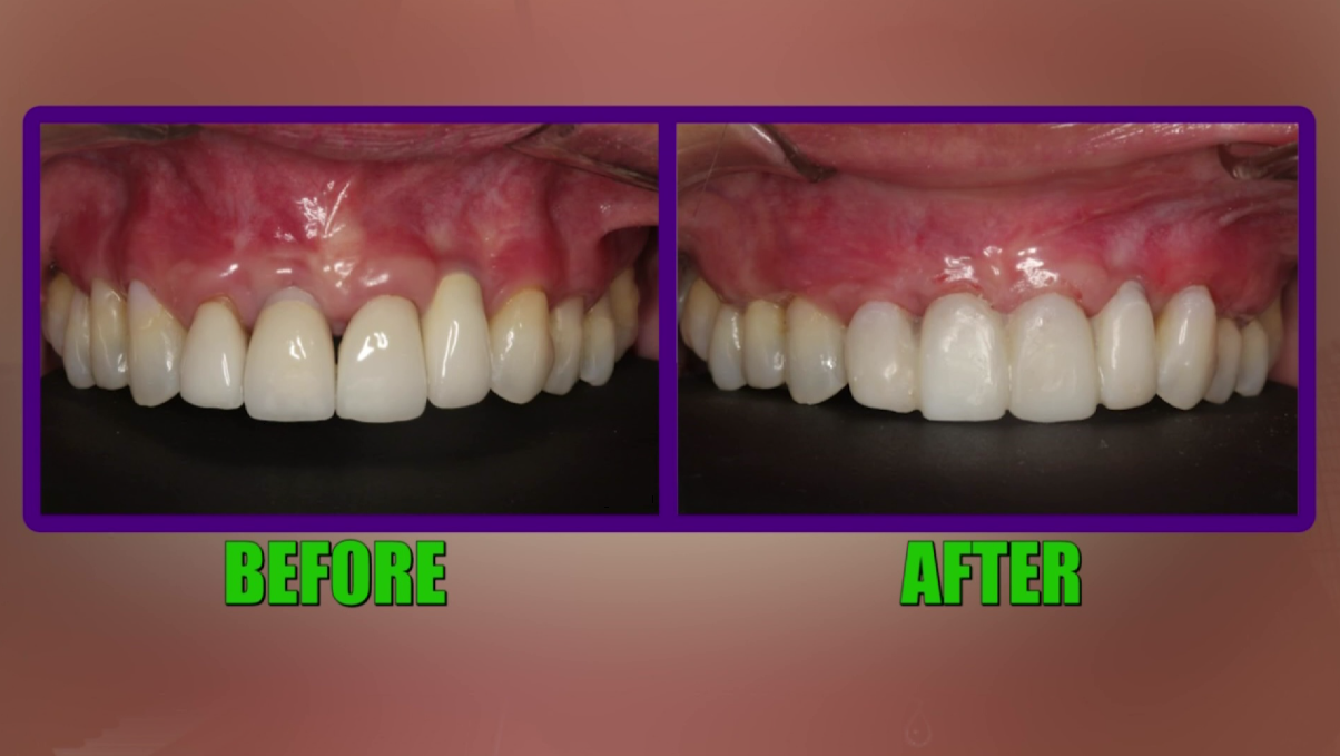 Gum Treatment