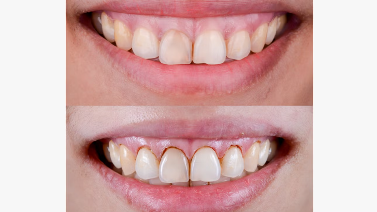Before and after smile transformation