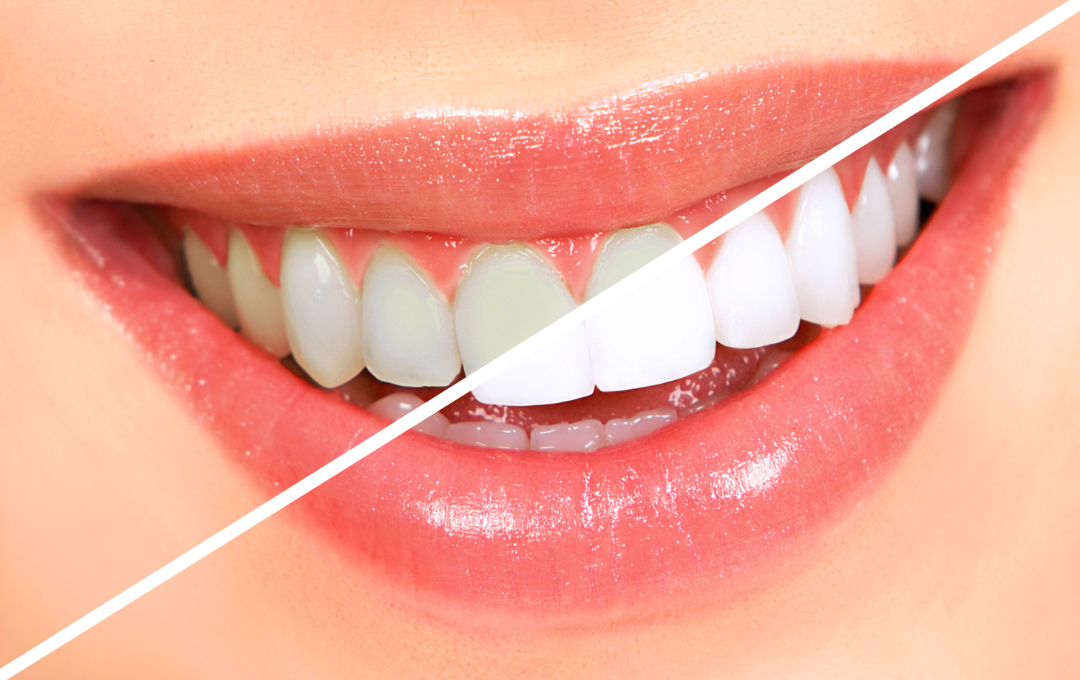 Teeth Whitening